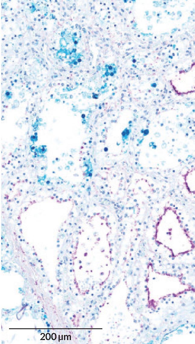 Клетки молочной железы коровы имеют на своей поверхности специфические сахара (на микроскопическом изображении они показаны фиолетовым цветом), которыми вирус H5N1 (синий) пользуется для проникновения и развития инфекции.
